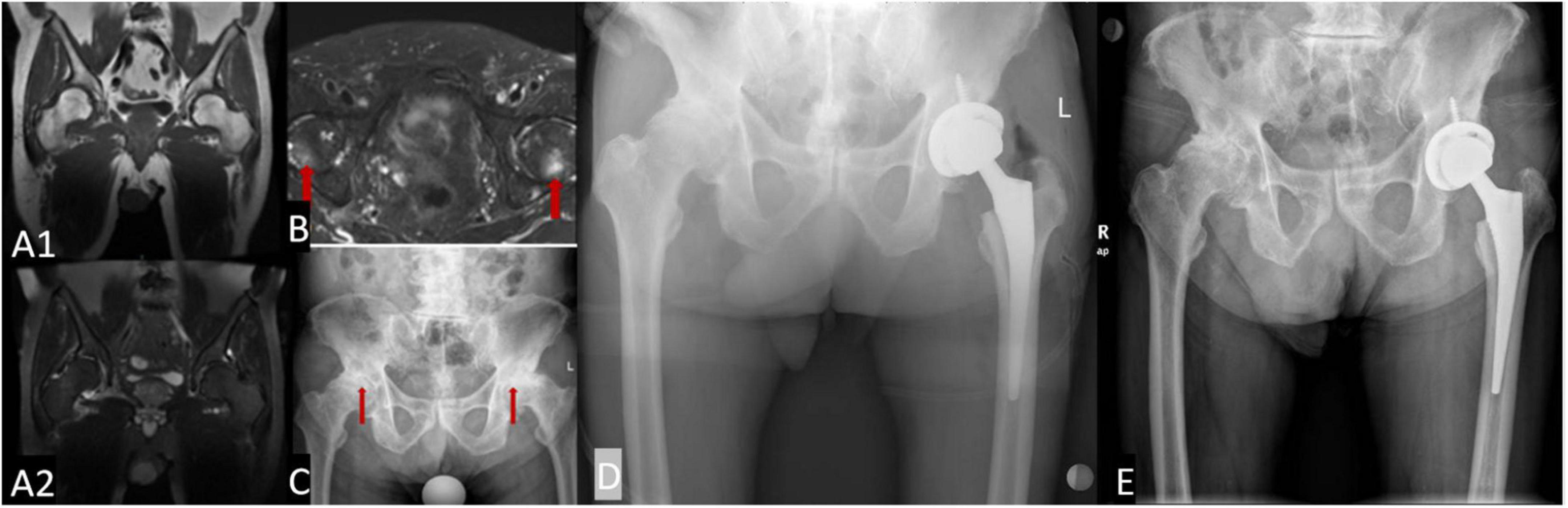 Frontiers Osteoradionecrosis of the Hip, a Troublesome Complication of Radiation Therapy Case Series and Systematic Review photo