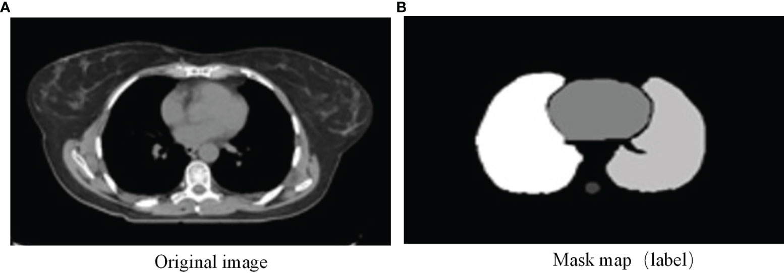 Impact of Neuroradiology-Based Peer Review on Head and Neck Radiotherapy  Target Delineation