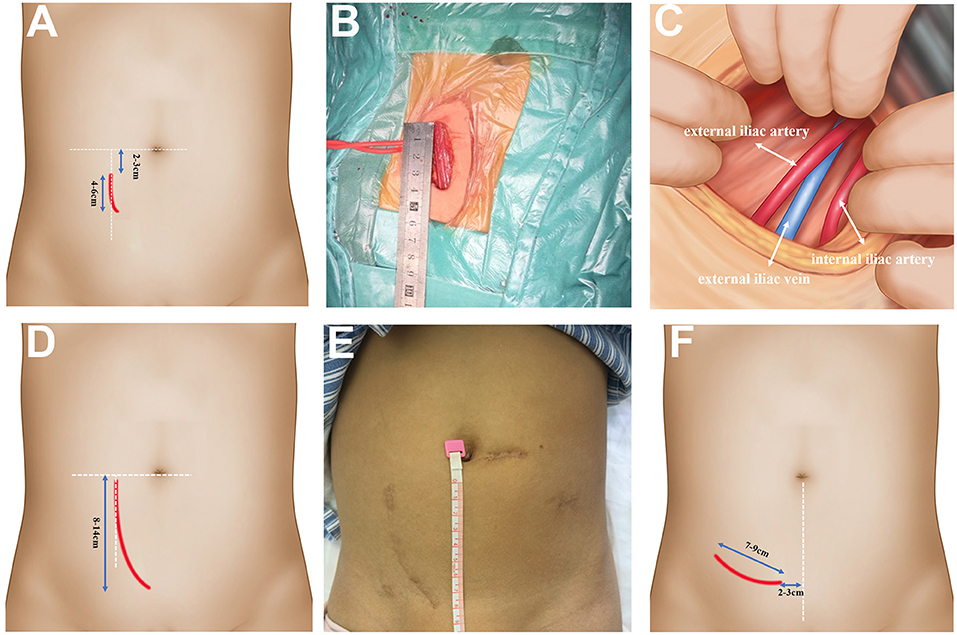 kidney transplant donor scar