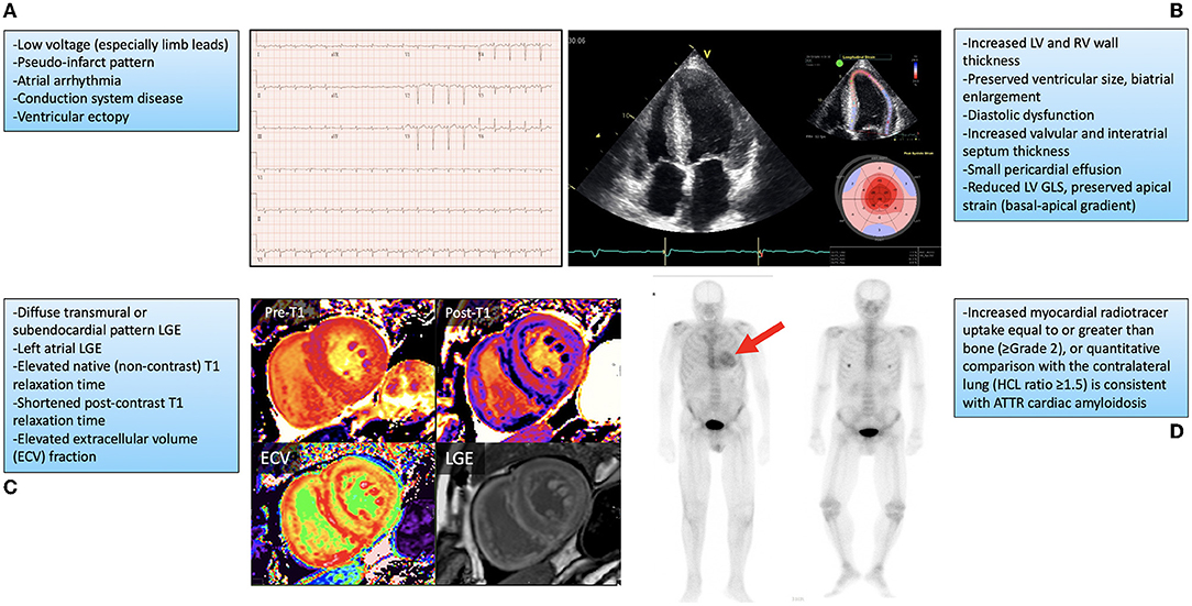 Diagnosis of Cardiac Amyloidosis Using Non-Invasive Technics