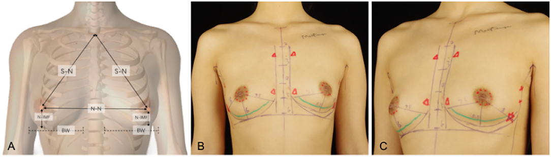 Descriptive analysis of ideal breast preferences (n = 135)