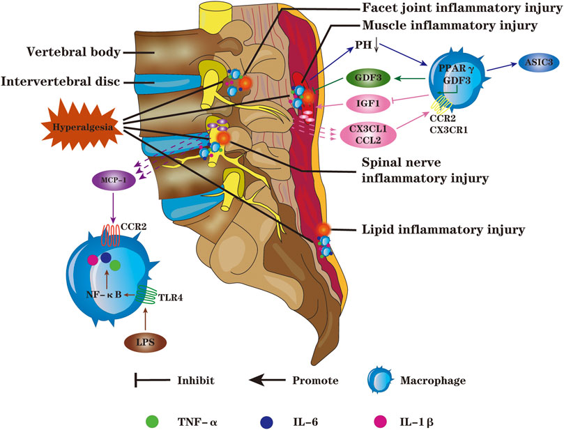 Frontiers  New Progress in Basic Research of Macrophages in the  Pathogenesis and Treatment of Low Back Pain