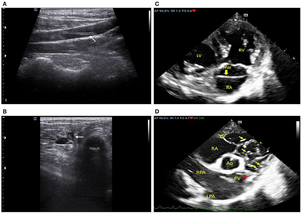 Frontiers | Case report: Thromboembolic heartworm induced lower limb ...