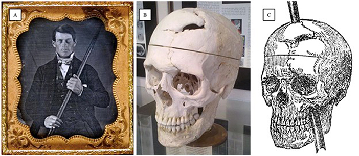 图1 - (A)菲尼亚斯·盖奇拿着穿过他大脑的捣固棒的照片。