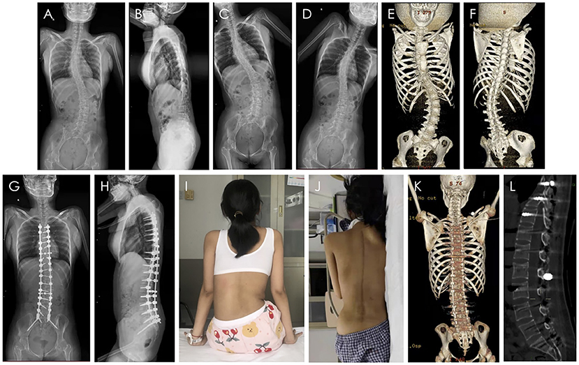 Scoliosis correction