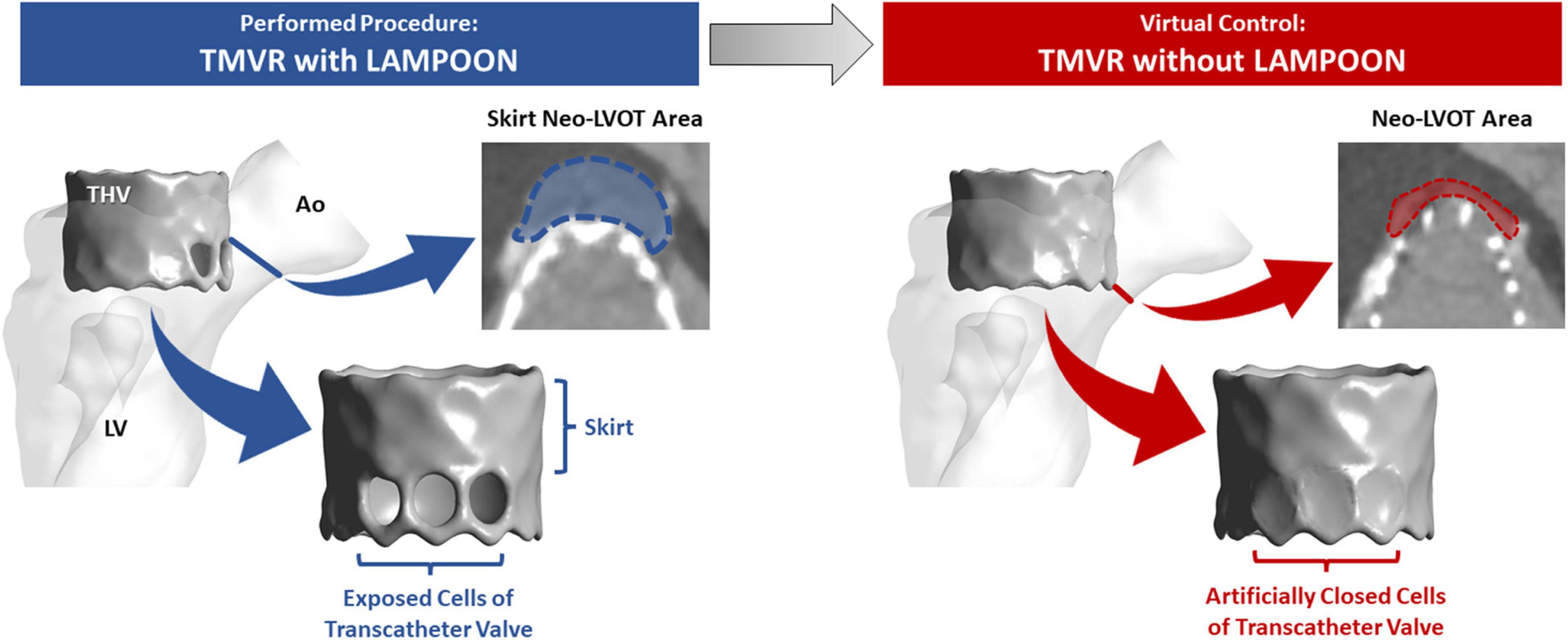 Metrics for defining LVOT obstruction based on pressure gradient