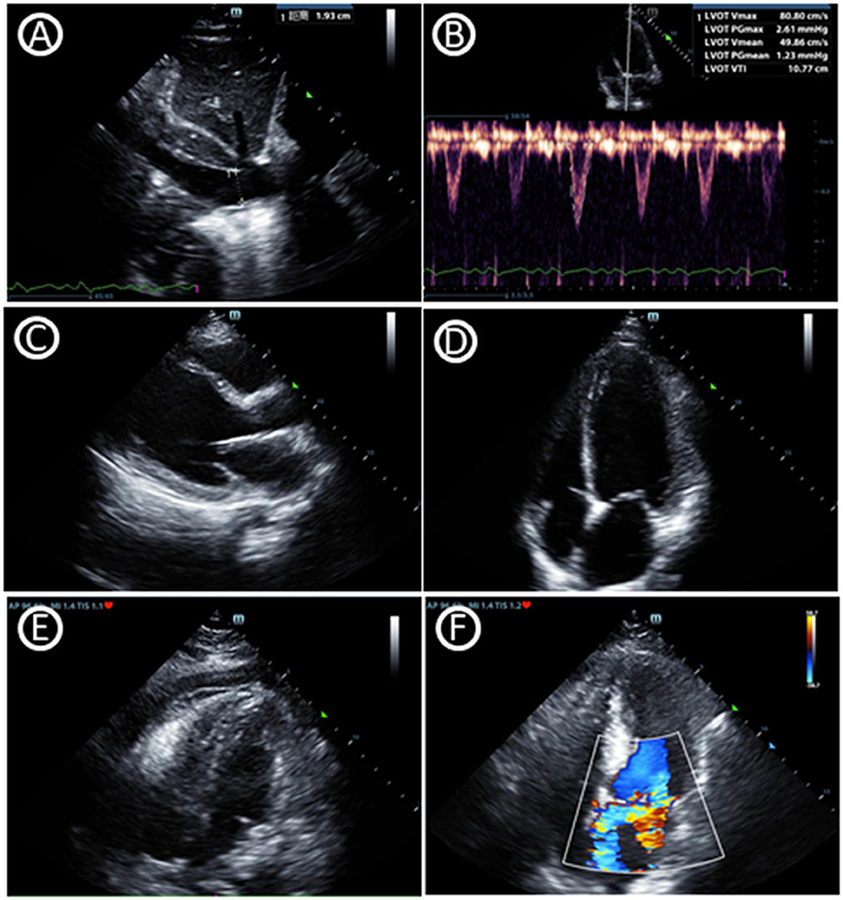 Point of Care Ultrasound Technology (POCUS) With AI