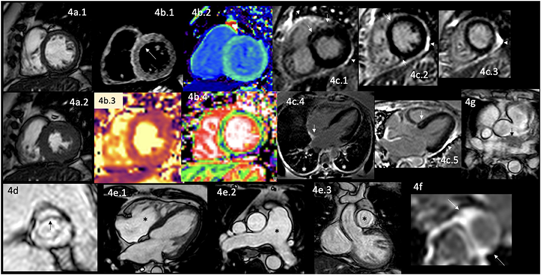 Frontiers | Cardiac Magnetic Resonance in Rheumatology to