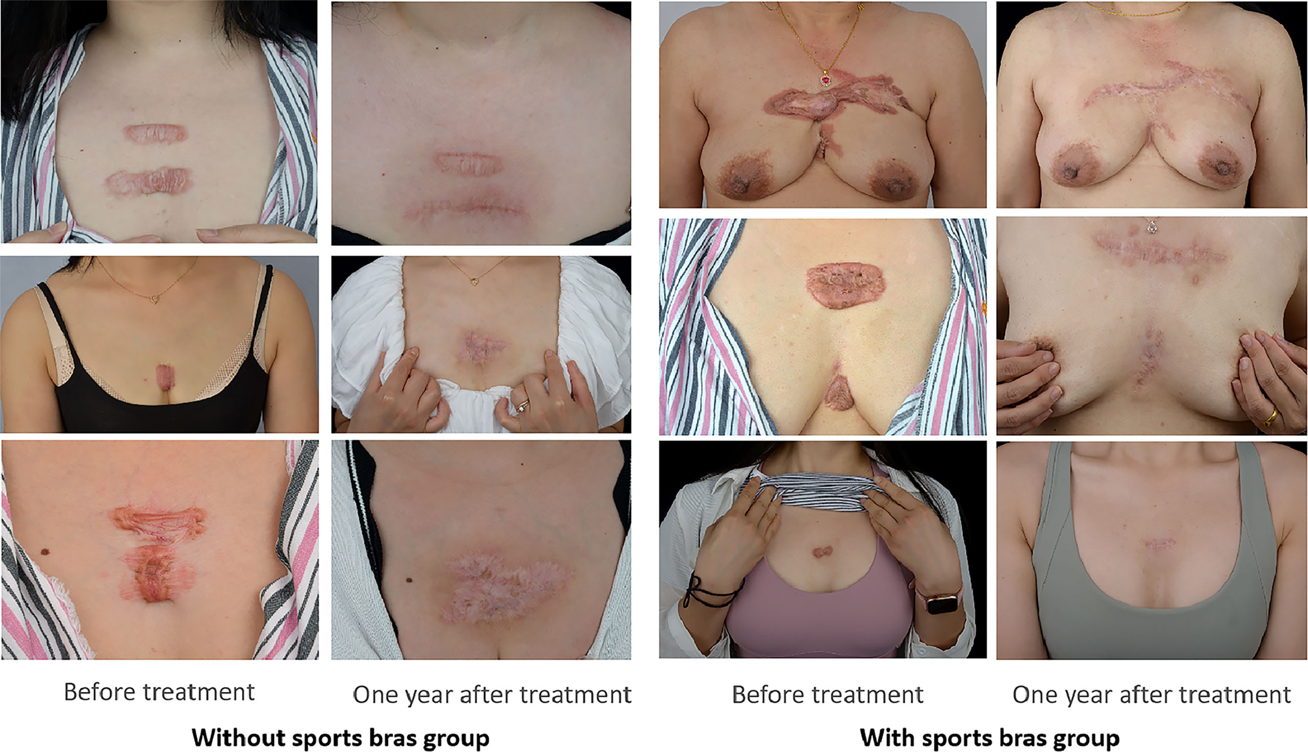 Frontiers  Sports Bras Improve Chest Keloids but Outcomes Are Dependent on  Breast Size: A Retrospective Analysis