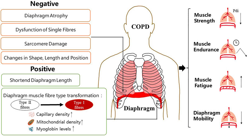 Frontiers Diaphragm Dysfunction And Rehabilitation Strategy In