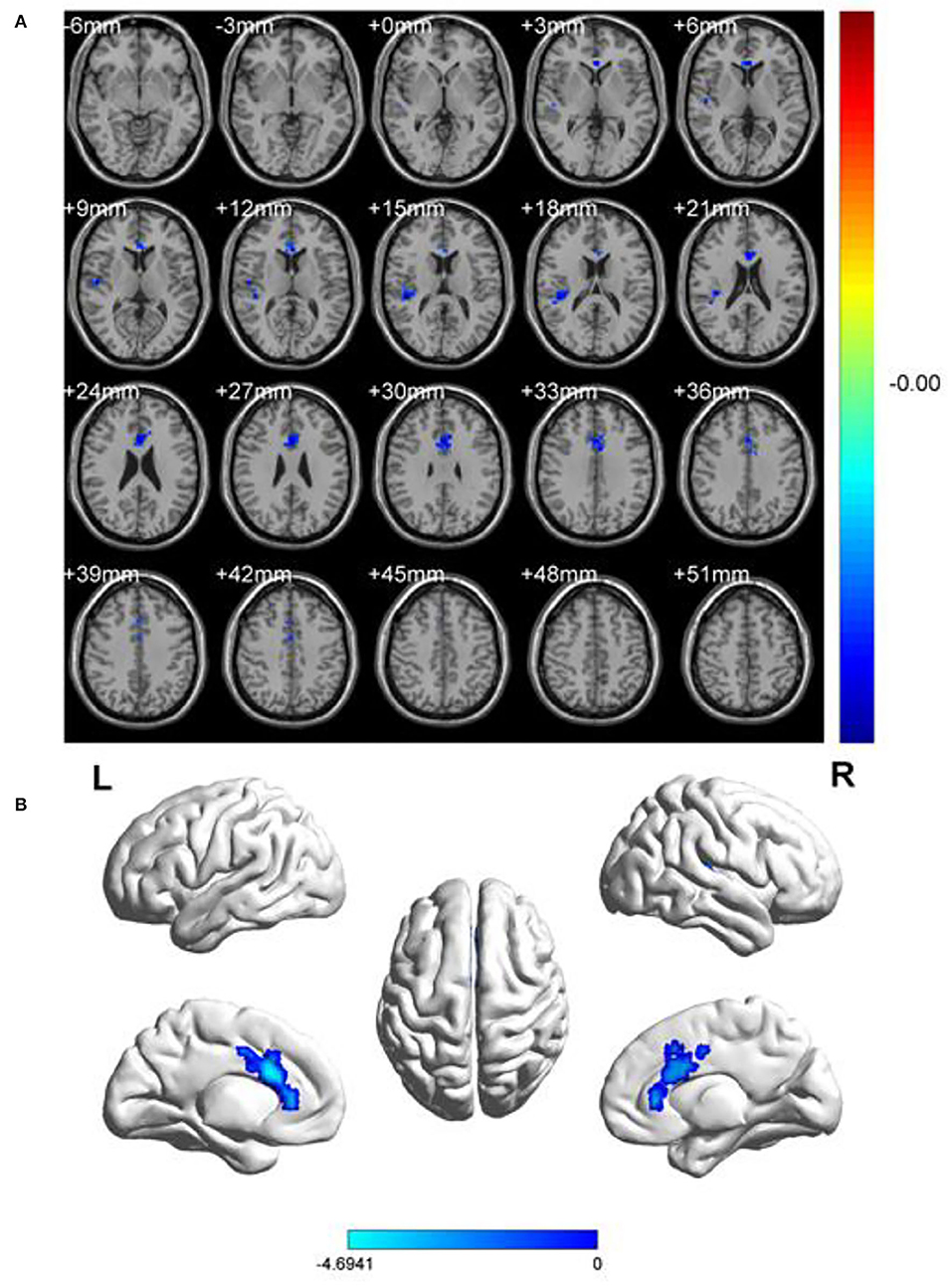 Frontiers  Abnormal brain spontaneous activity in major