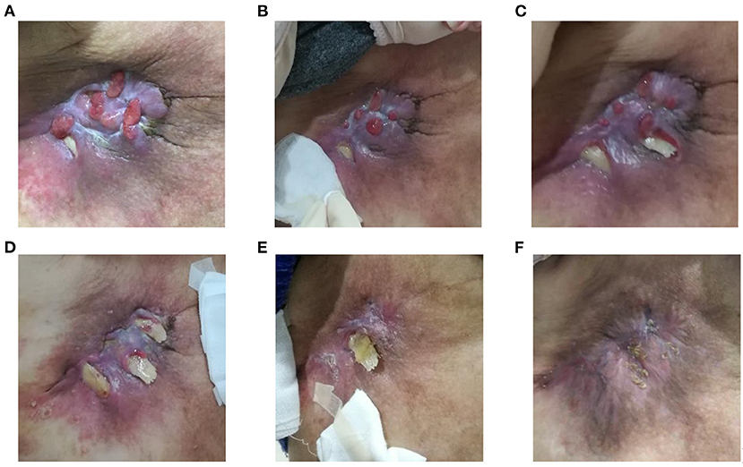 Ulceration of Breast's Skin due to Topical Corticosteroid Abuse - Open  Access Pub