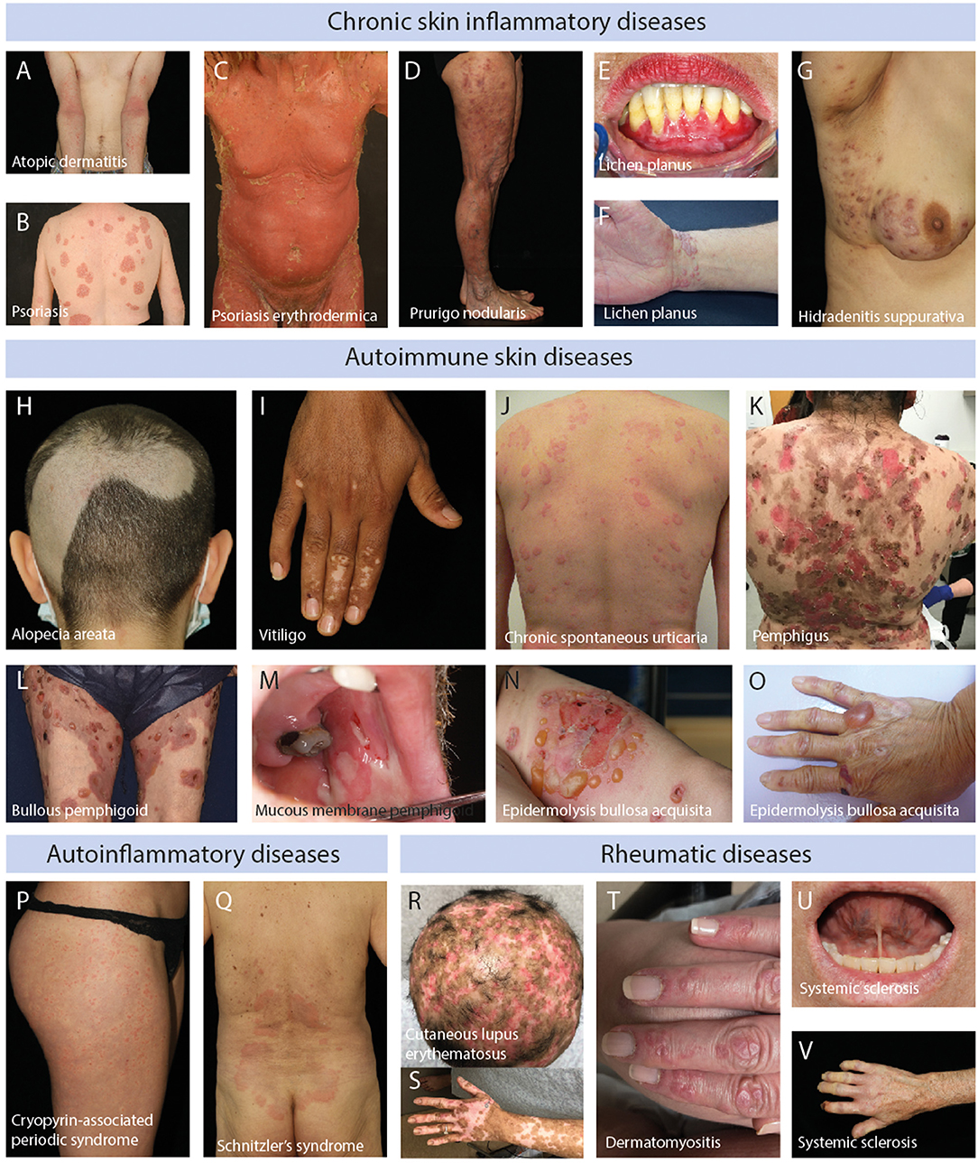 Frontiers  Unmet Medical Needs in Chronic, Non-communicable Inflammatory  Skin Diseases