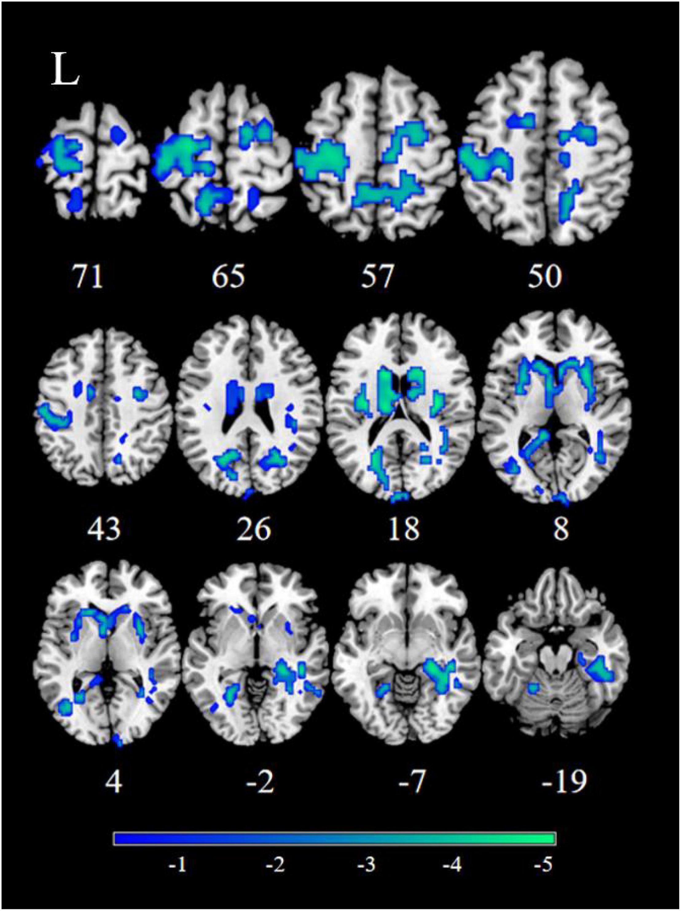 Frontiers Neural activity in adults with major depressive disorder differs from that in healthy individuals: A resting-state functional magnetic resonance imaging study