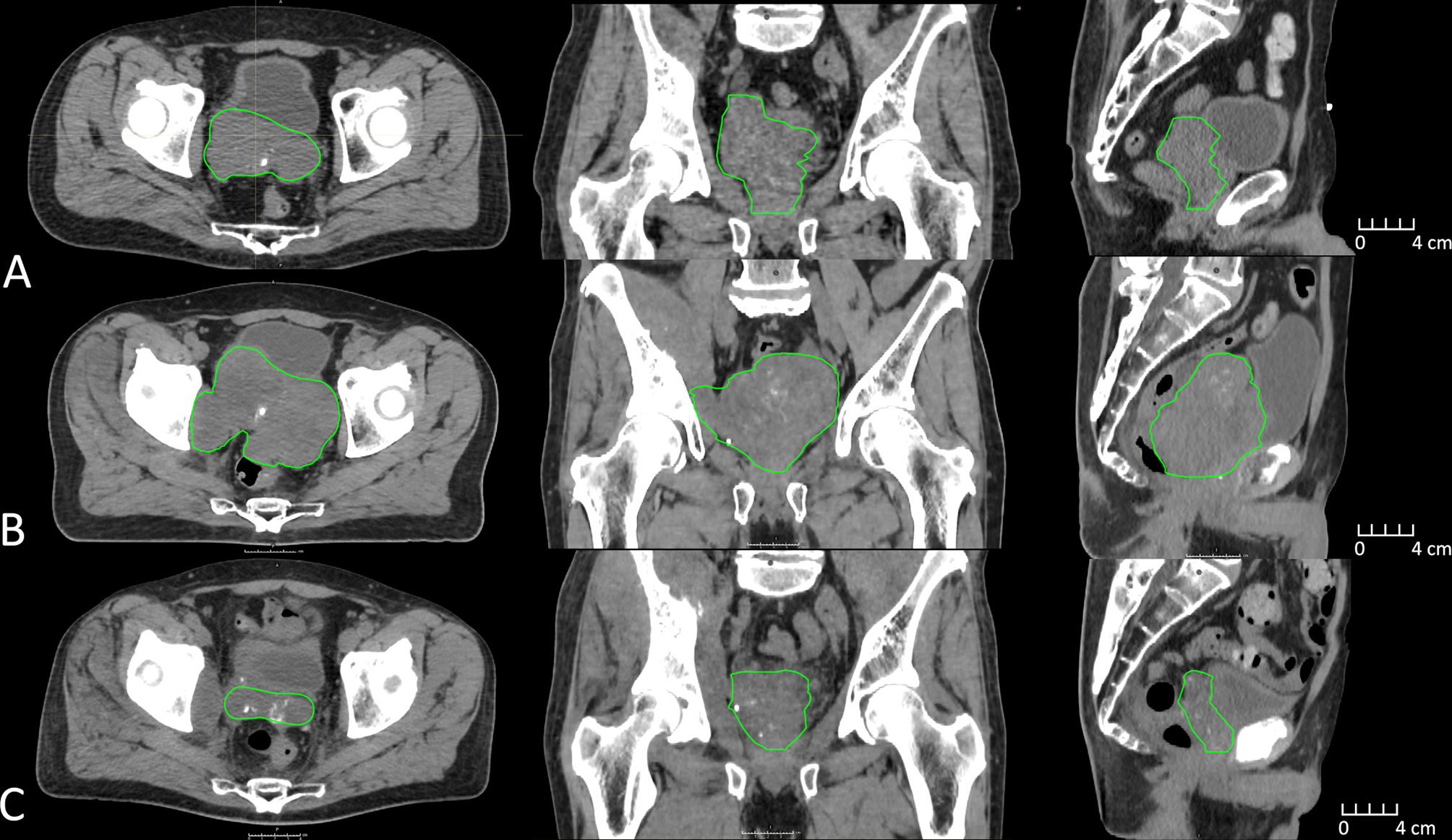 Early Complications of radiotherapy. United Imaging CT.