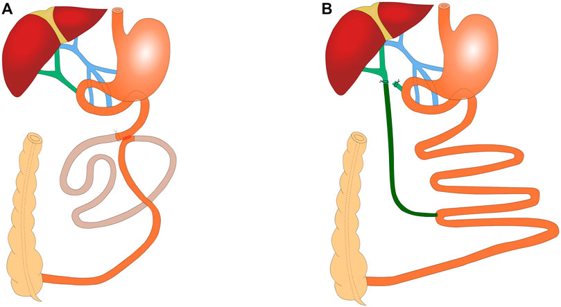 Esophagus-duodenum Gastric Bypass Surgery Improves Glucose and Lipid  Metabolism in Mice - eBioMedicine