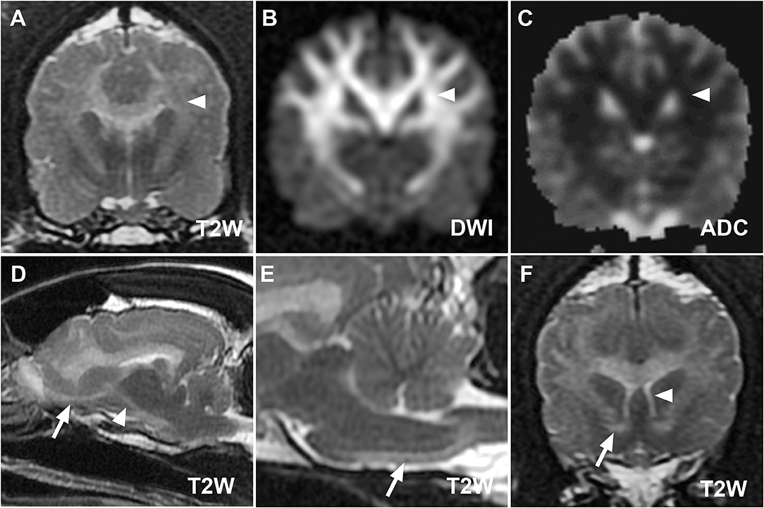 Frontiers Case Report MRI, Clinical, and Pathological Correlates of