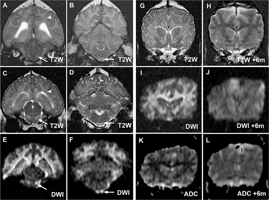 Frontiers Case Report MRI, Clinical, and Pathological Correlates of
