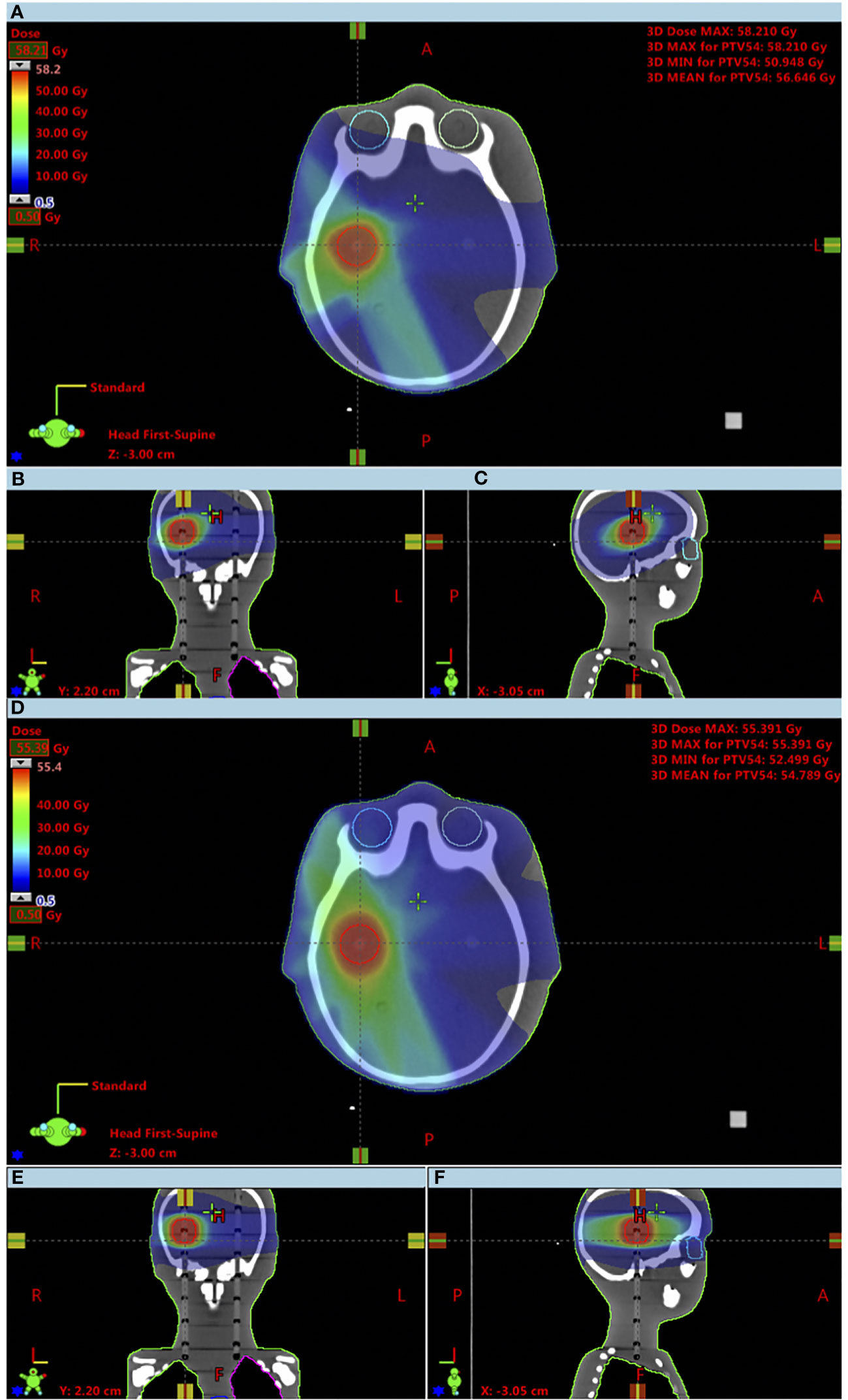 Frontiers Comparison of 3DCRT and IMRT outoffield doses in