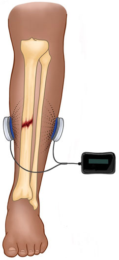 Can a bone stimulator help a stress fracture? 