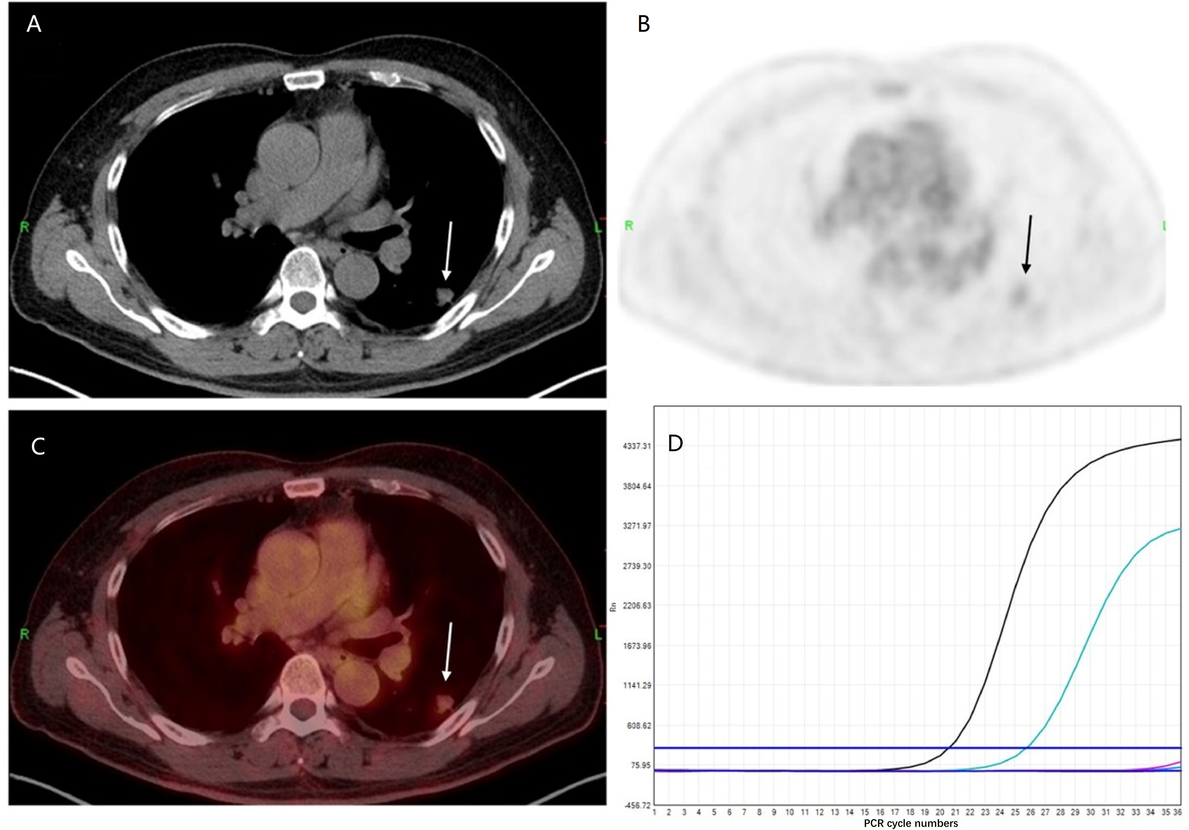Frontiers | Recent and current advances in PET/CT in the field of predicting epidermal growth factor receptor mutations in cell lung cancer