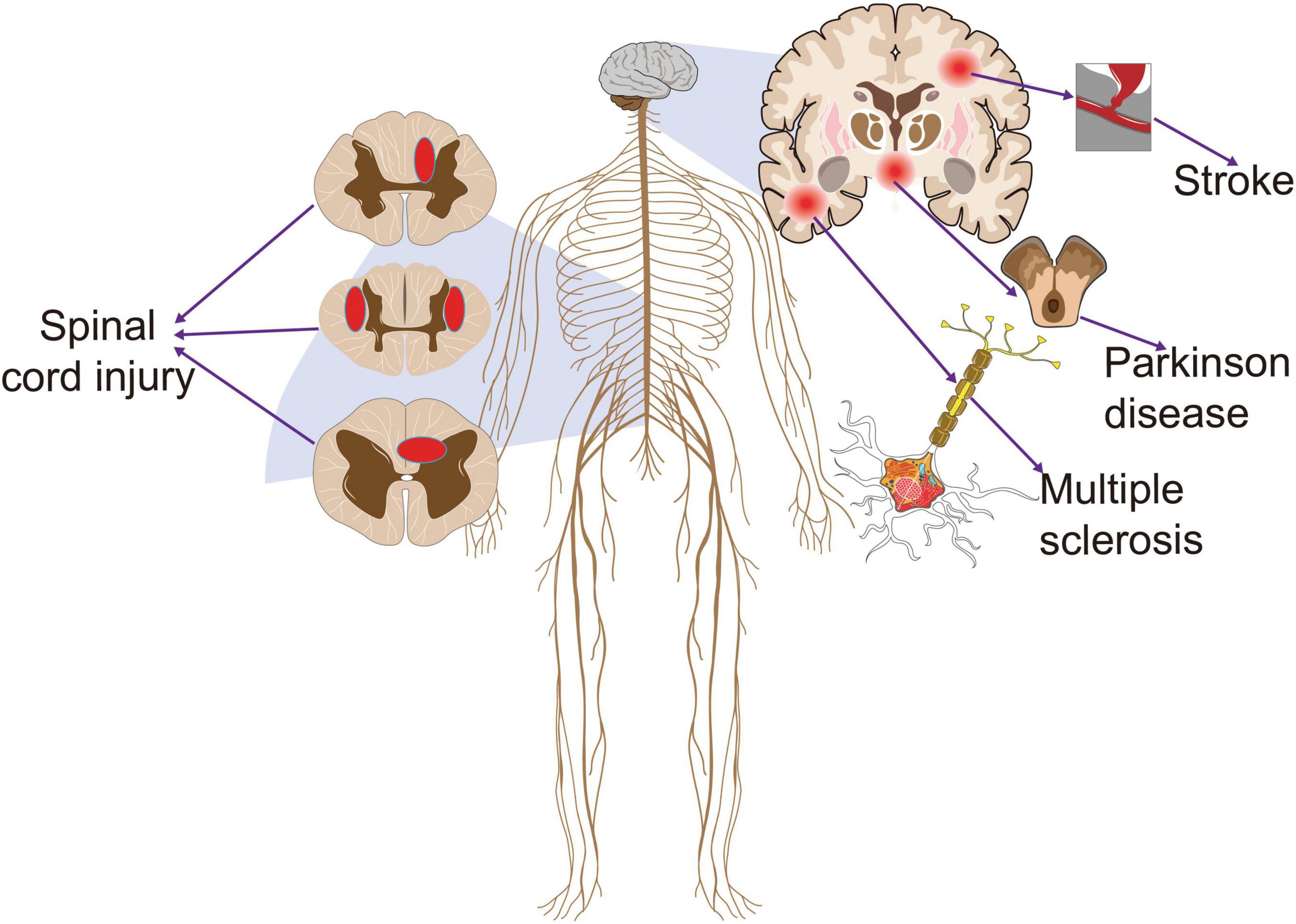 Treat Pain With Non-Drug Non-Invasive Electrical Stimulation