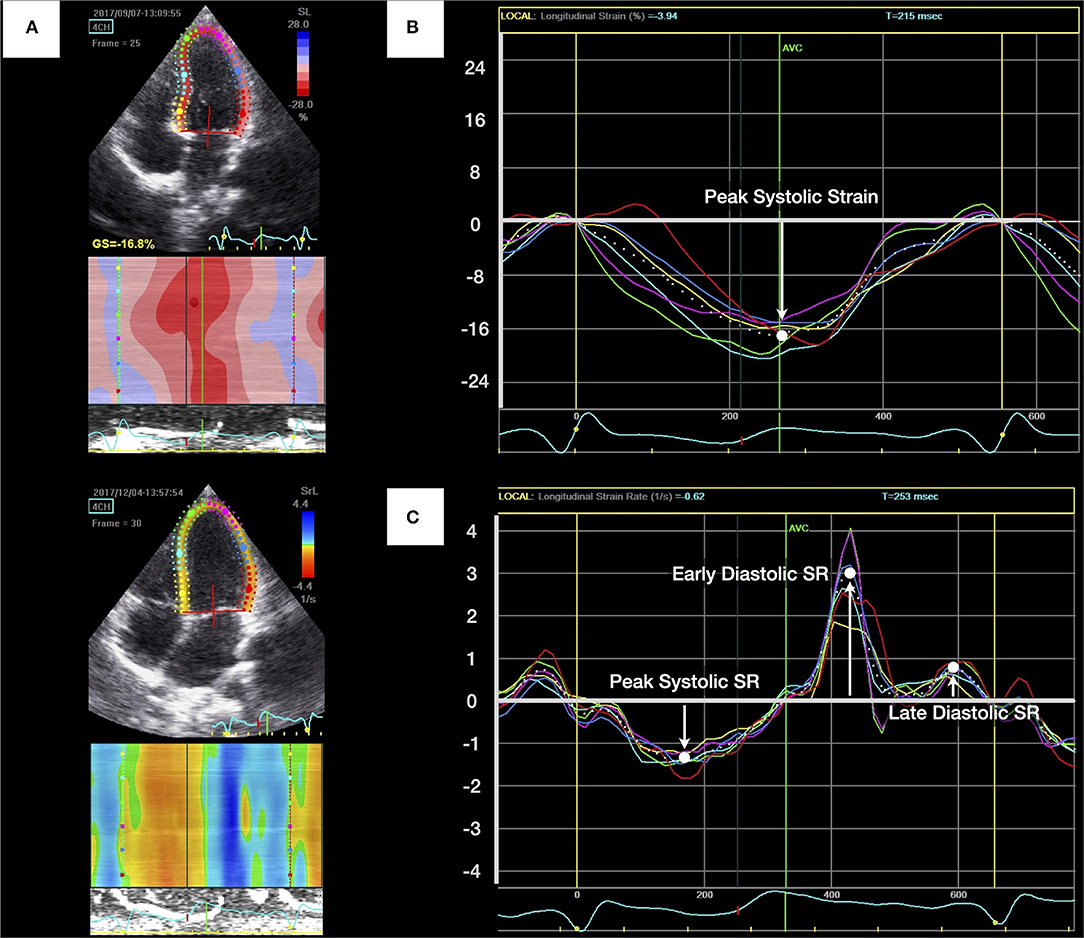 A systematic review and meta-analysis of the normal reference value of the  longitudinal left atrial strain by three dimensional speckle tracking  echocardiography