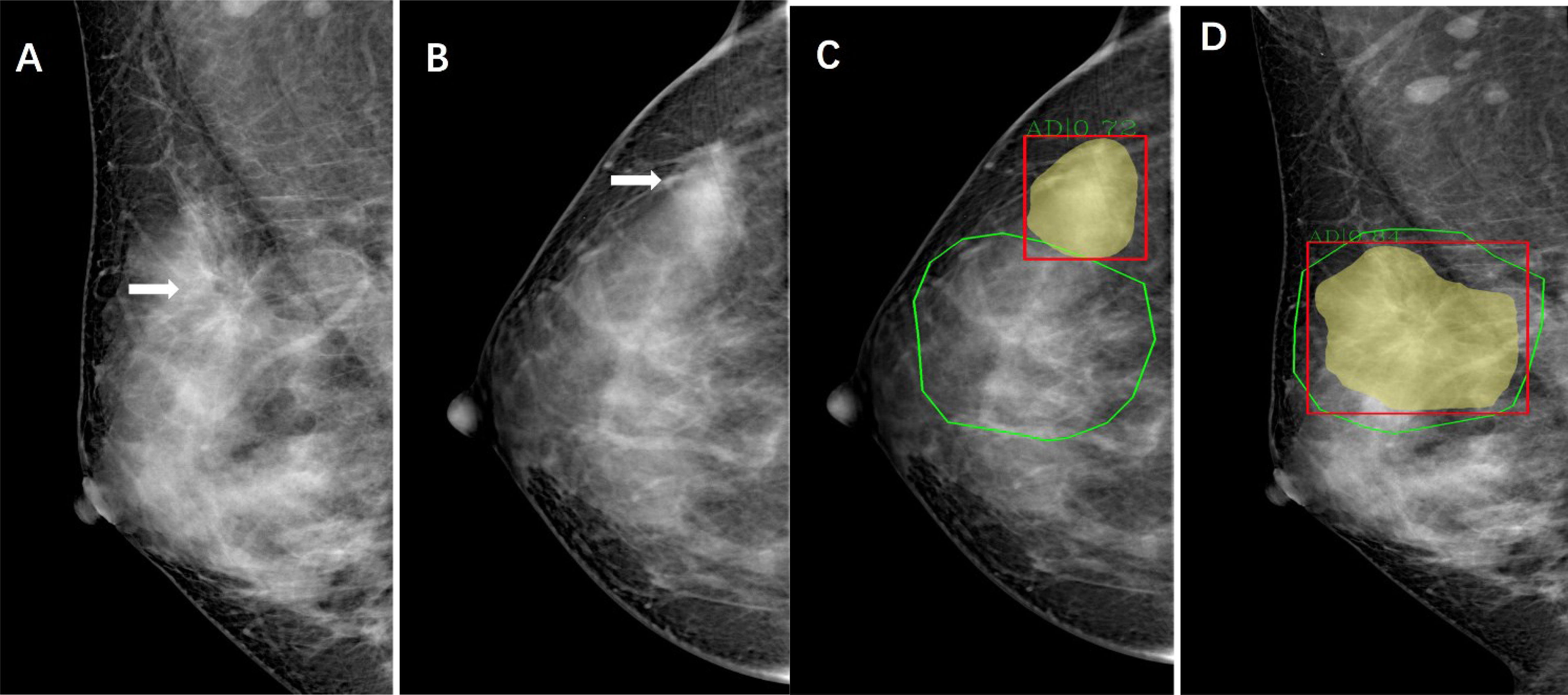 Frontiers | Evaluation of the Combination of Artificial Intelligence and  Radiologist Assessments to Interpret Malignant Architectural Distortion on  Mammography