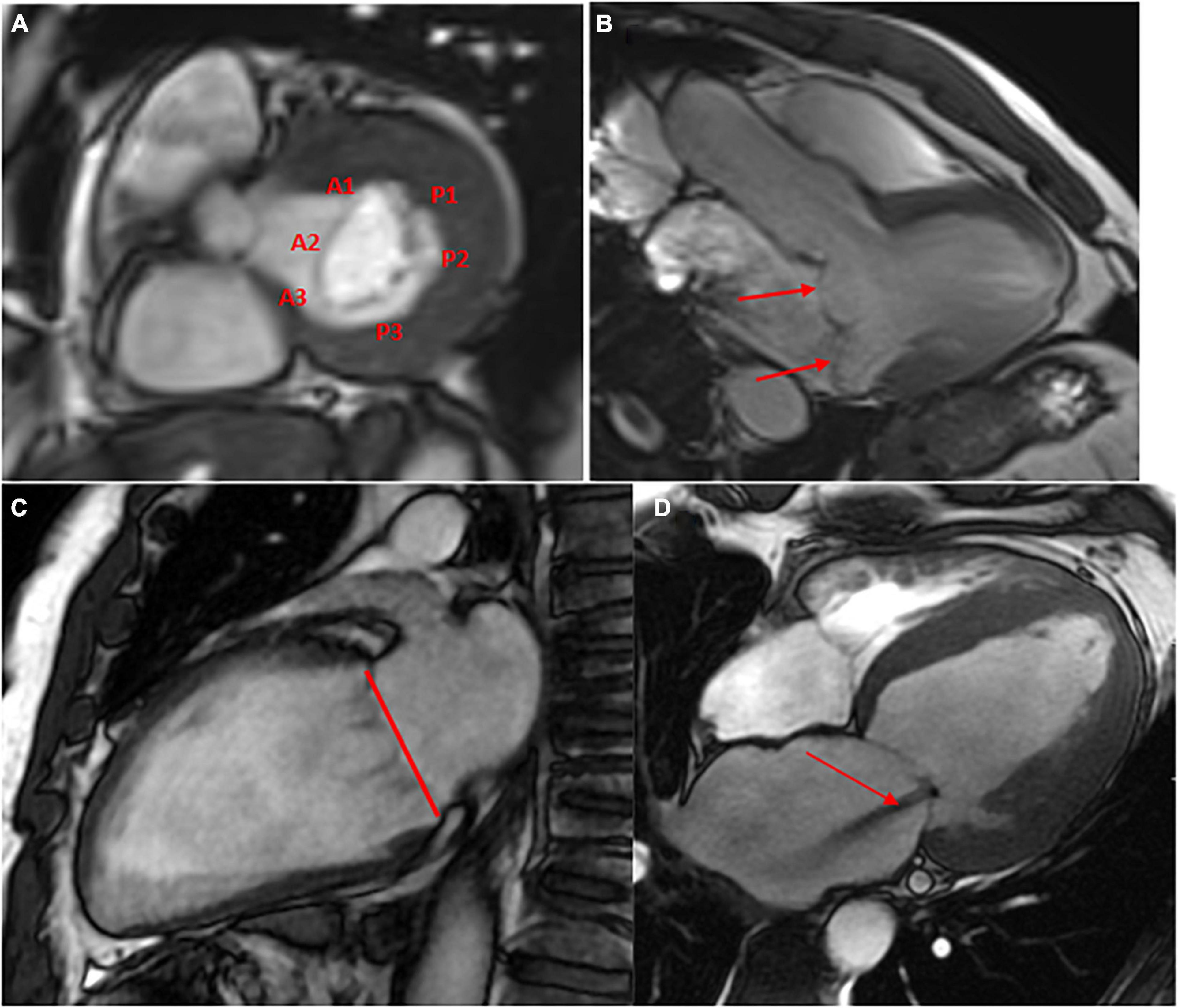 Frontiers | Role of Cardiovascular Magnetic Resonance in Native Valvular A Comprehensive Review of Protocols, Grading of Severity, and Prediction of