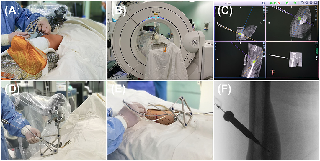 First robotic-assisted intracranial implant of Cerus Endovascular
