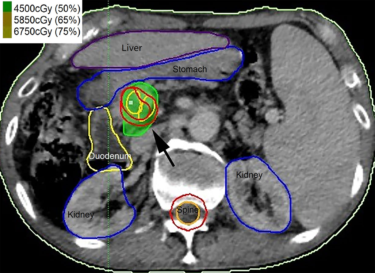 Frontiers  Hypofractionated Radiotherapy for Palliation of Main Portal Vein  Tumor Thrombosis