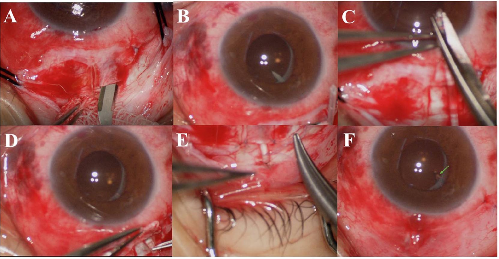 Ahmed Glaucoma Valve - Simovision BV