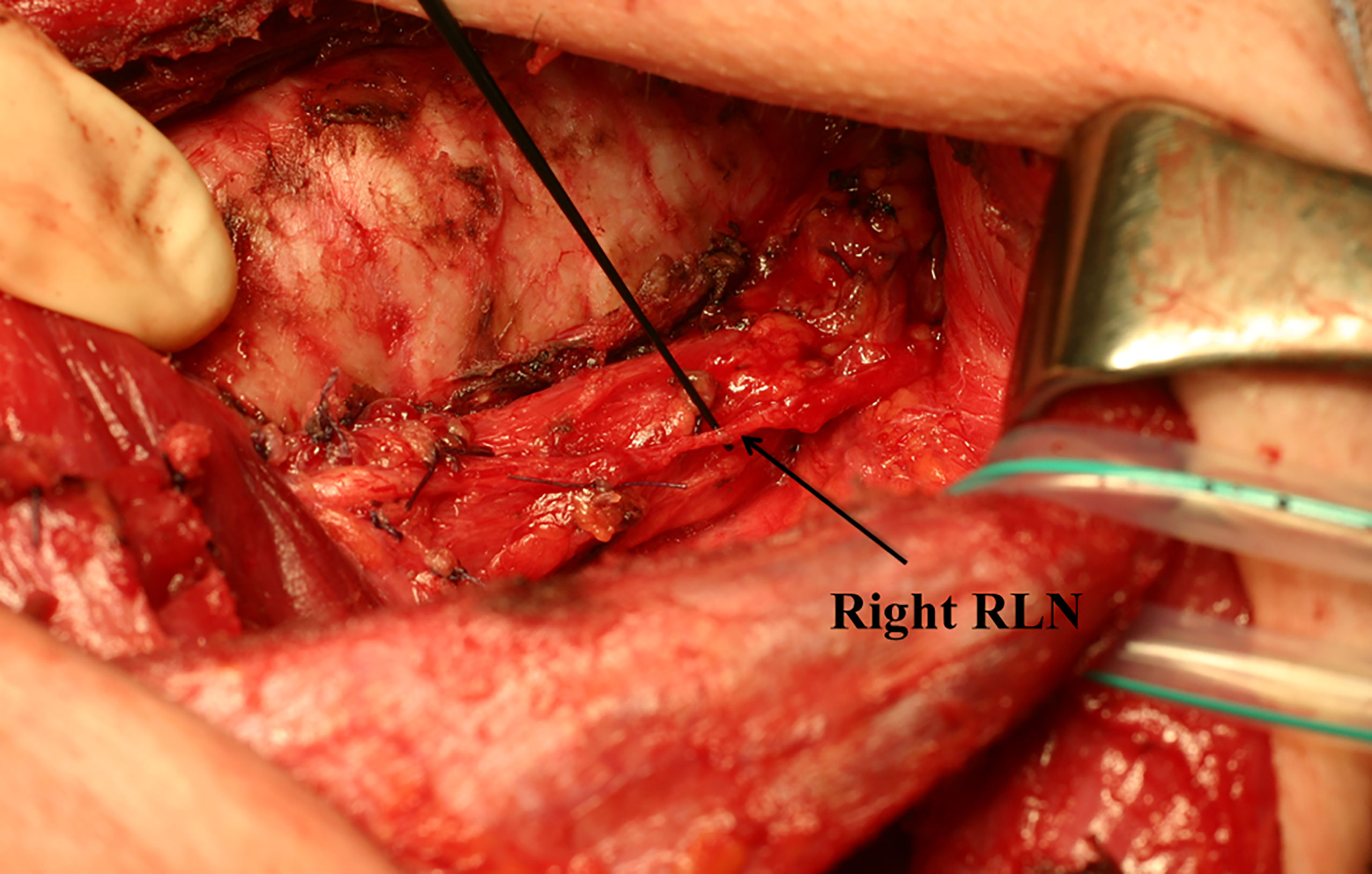 Surgical anatomy of the external branch of the superior laryngeal