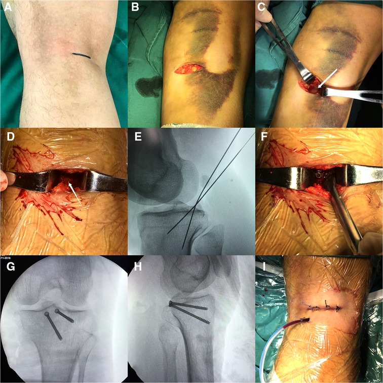 Tibial Spine Fractures  Florida Orthopaedic Institute