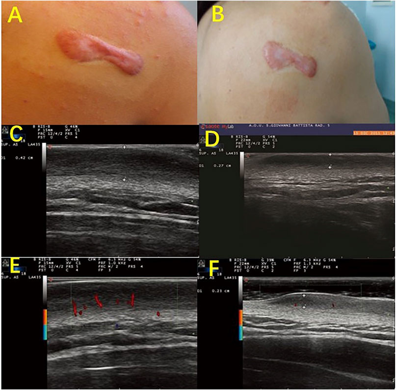 High Frequency Ultrasound in Aesthetic Dermatology Novel Research