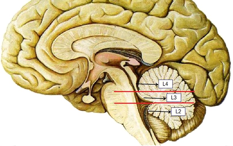 VP shunt placement for hydrocephalus after posterior fossa