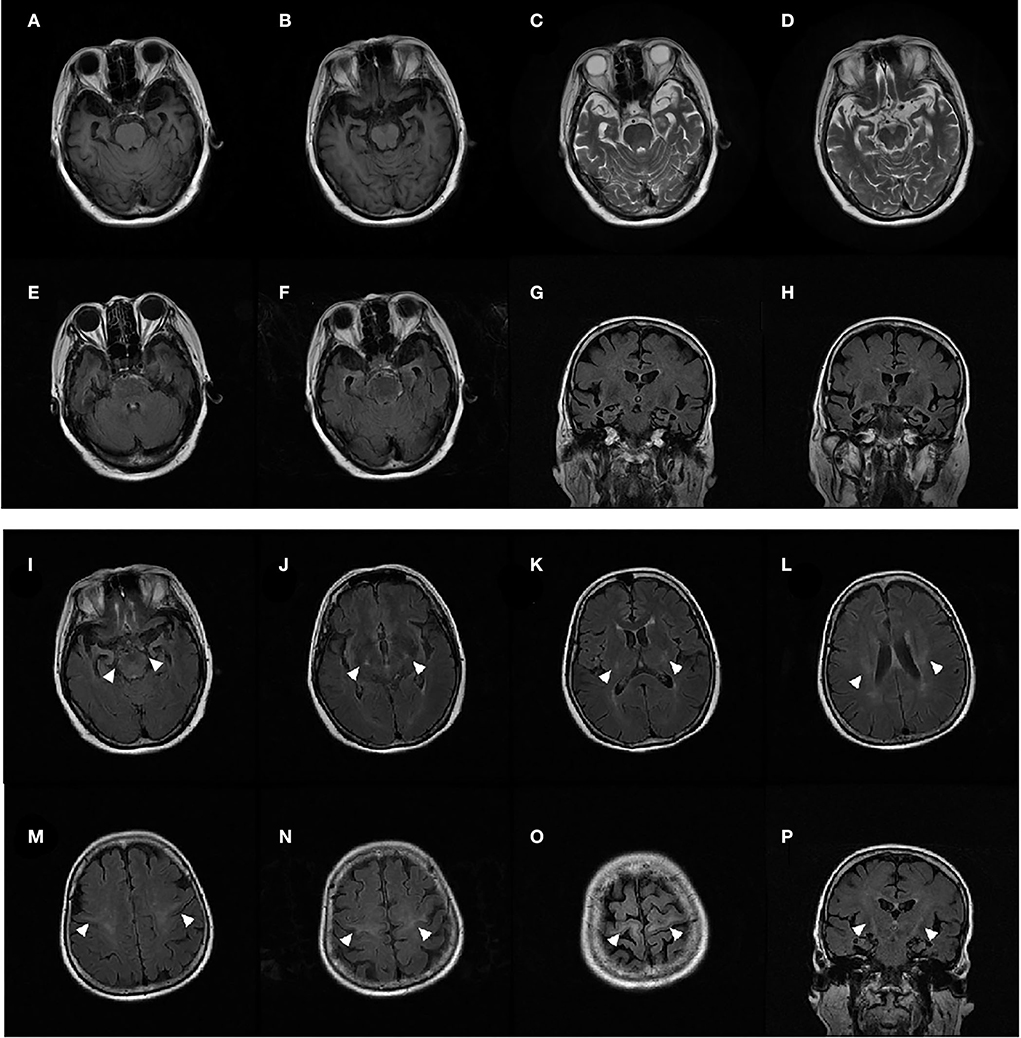 Frontiers | ANXA11 mutations are associated with amyotrophic lateral ...