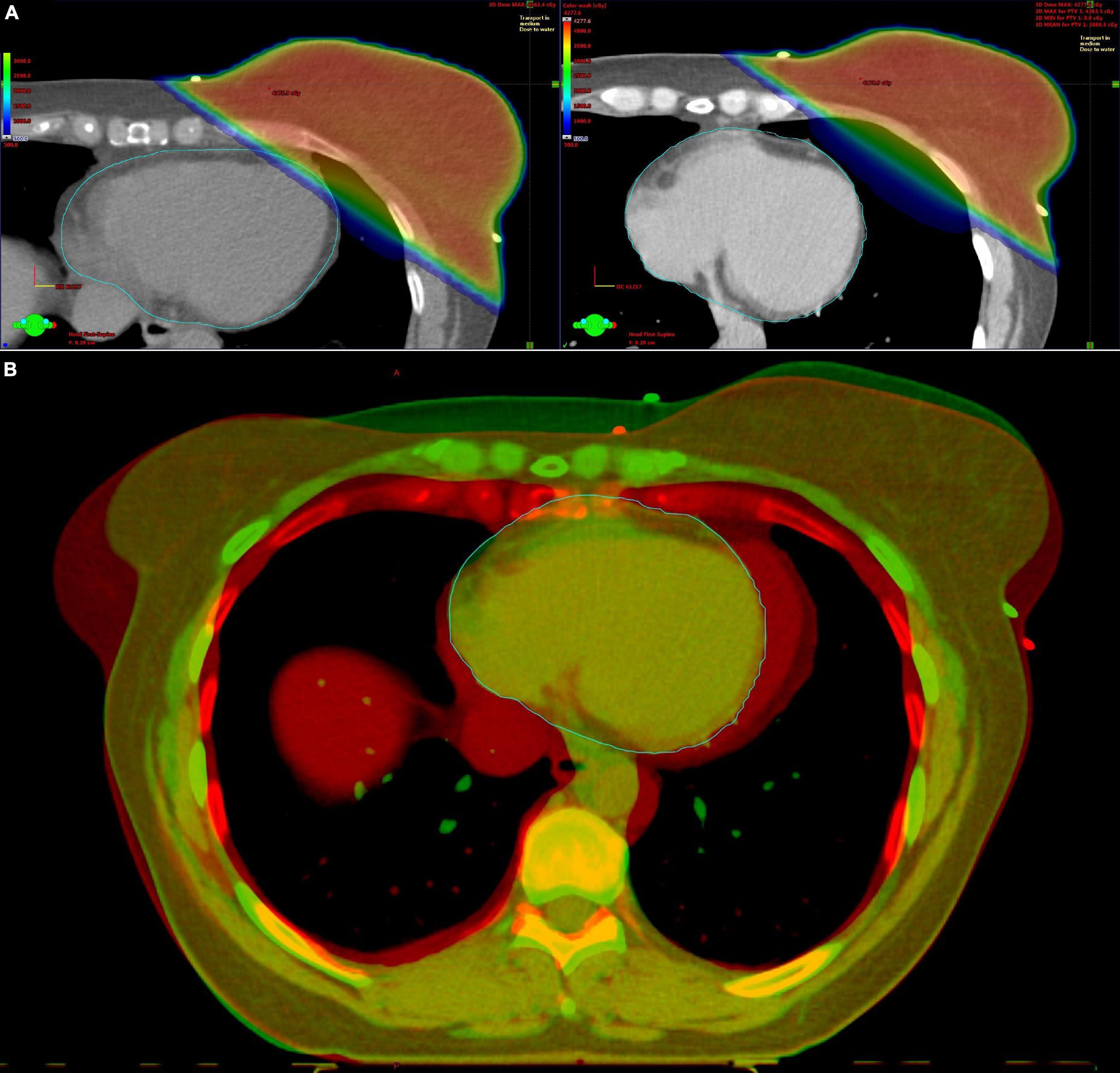 Case Study: Using Strain Echo to Recognize Cardiotoxicity from