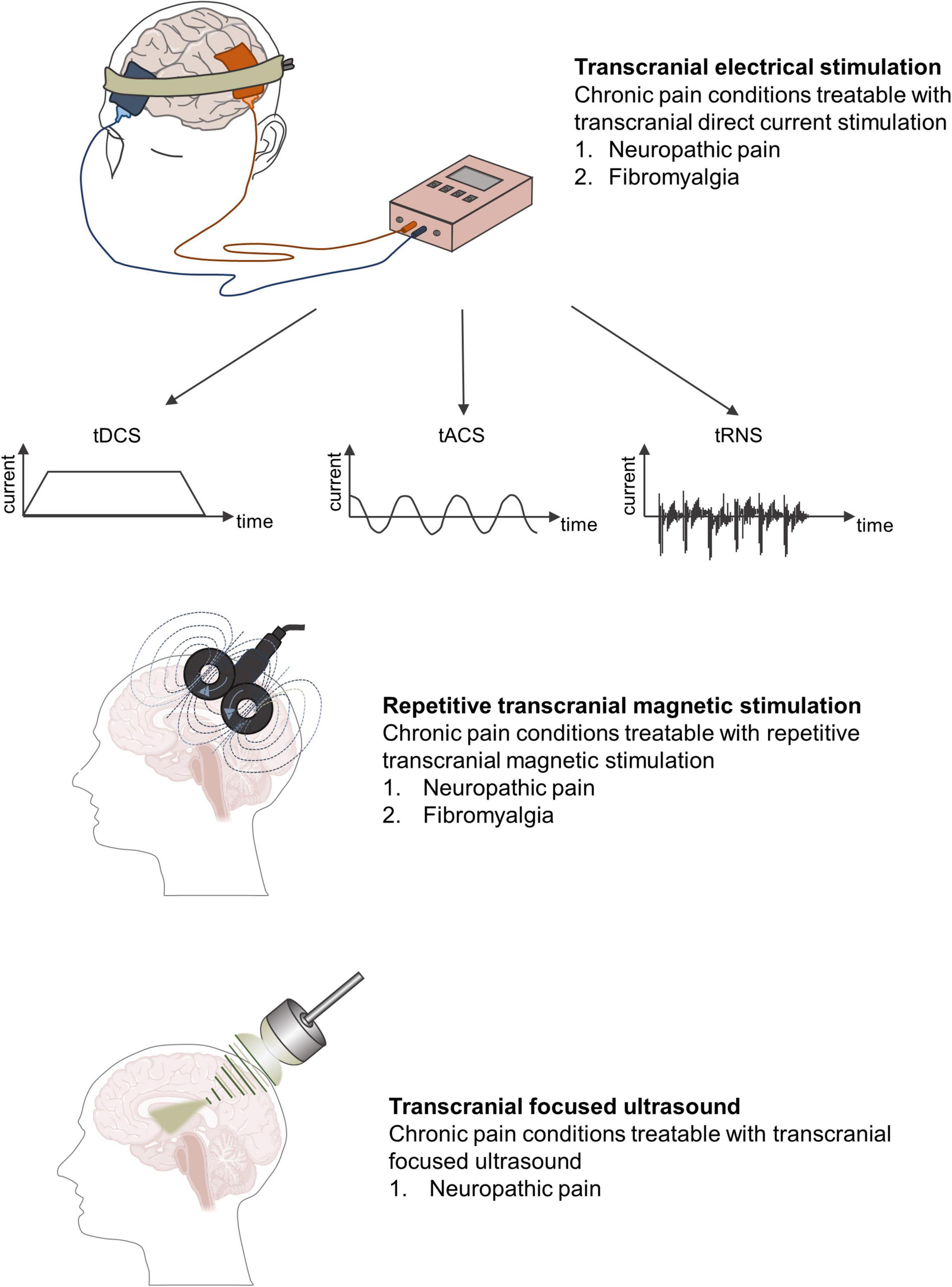 Treat Pain With Non-Drug Non-Invasive Electrical Stimulation