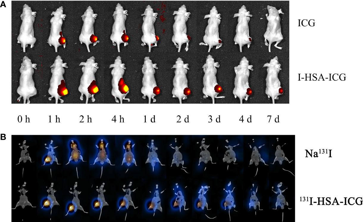 HSA-MnO2-131I Combined Imaging and Treatment of Anaplastic Thyroid