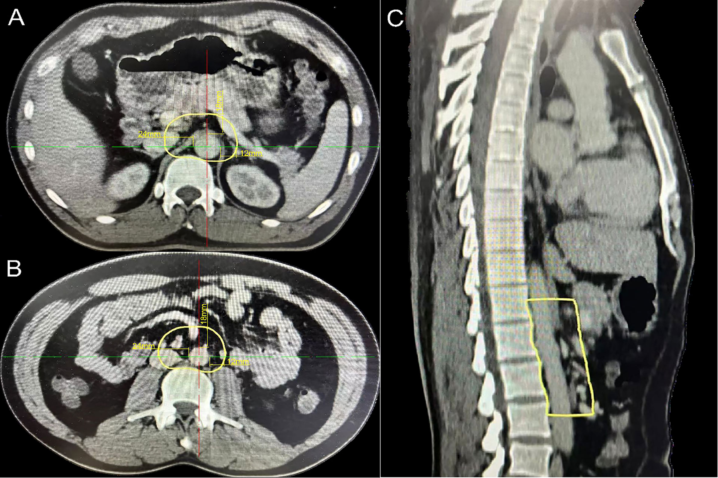 Frontiers | Recommendations of the clinical target volume