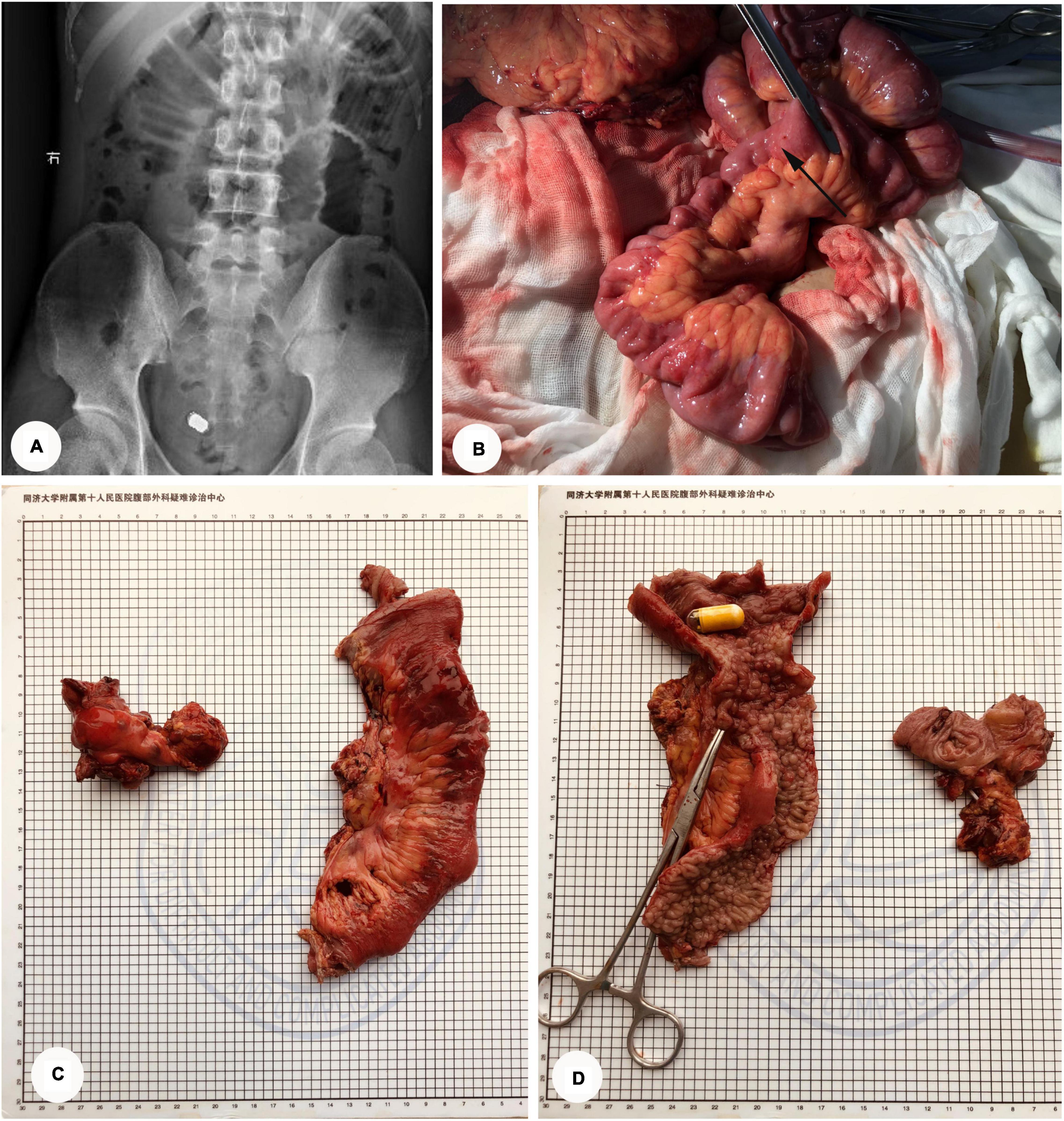 Frontiers  Crohn's Disease Complicated by Rare Types of