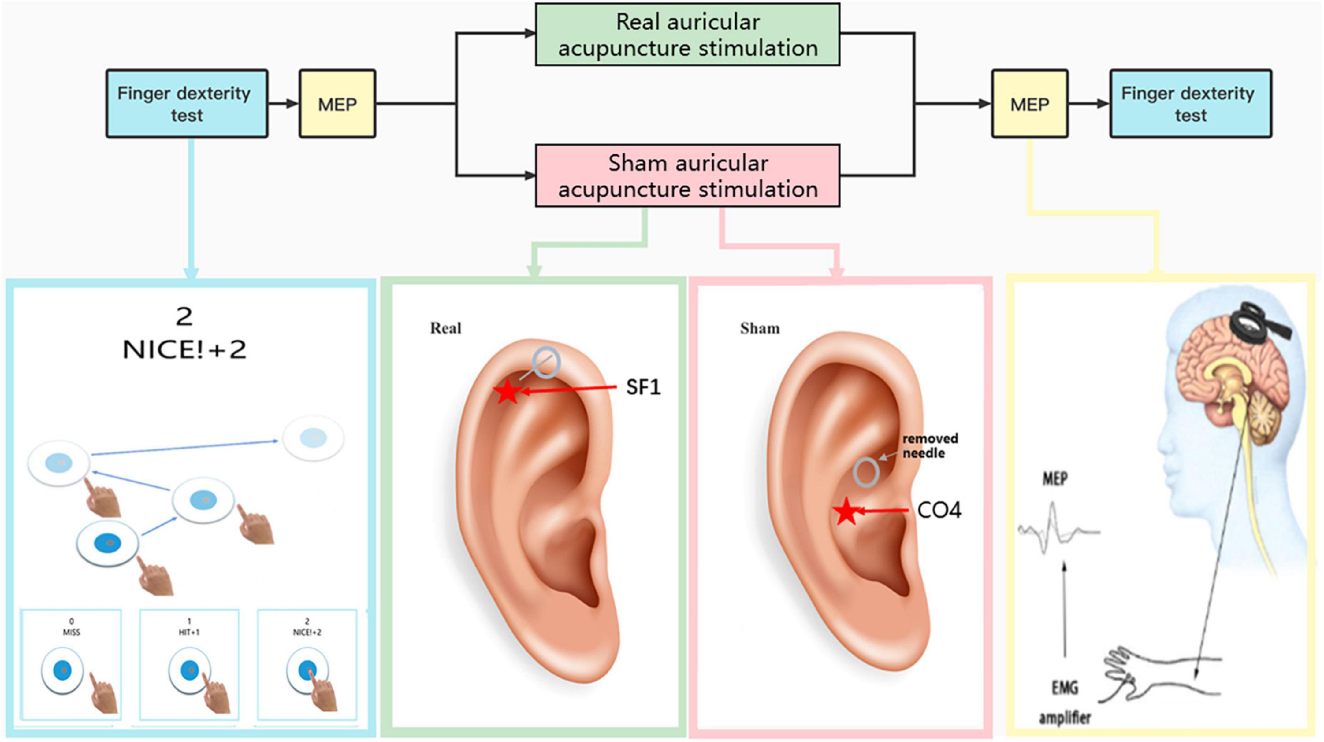 Electrical Dry Needling for Auricular Vagus Nerve Stimulation