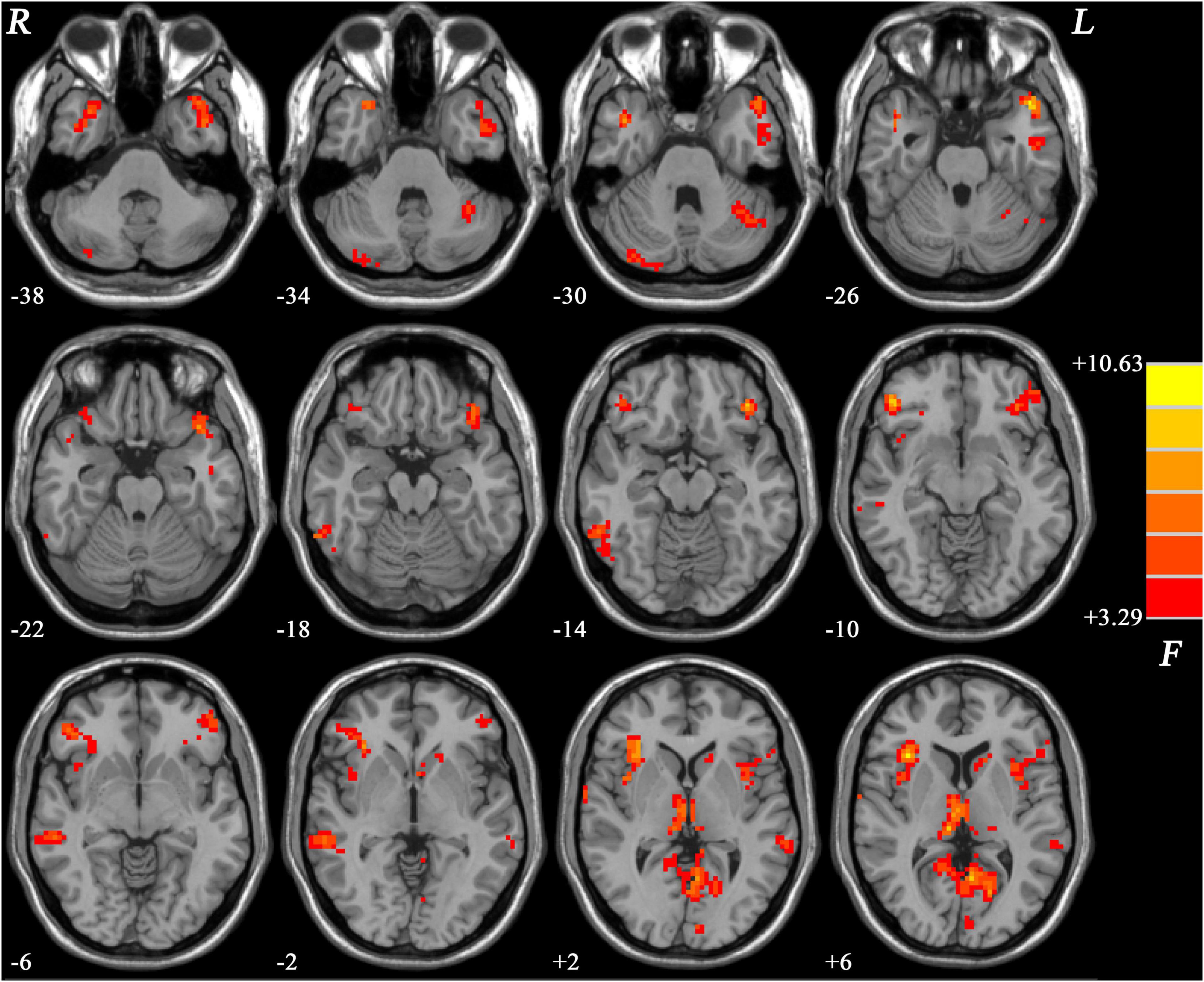 Frontiers  Neural activity in adults with major depressive disorder  differs from that in healthy individuals: A resting-state functional  magnetic resonance imaging study