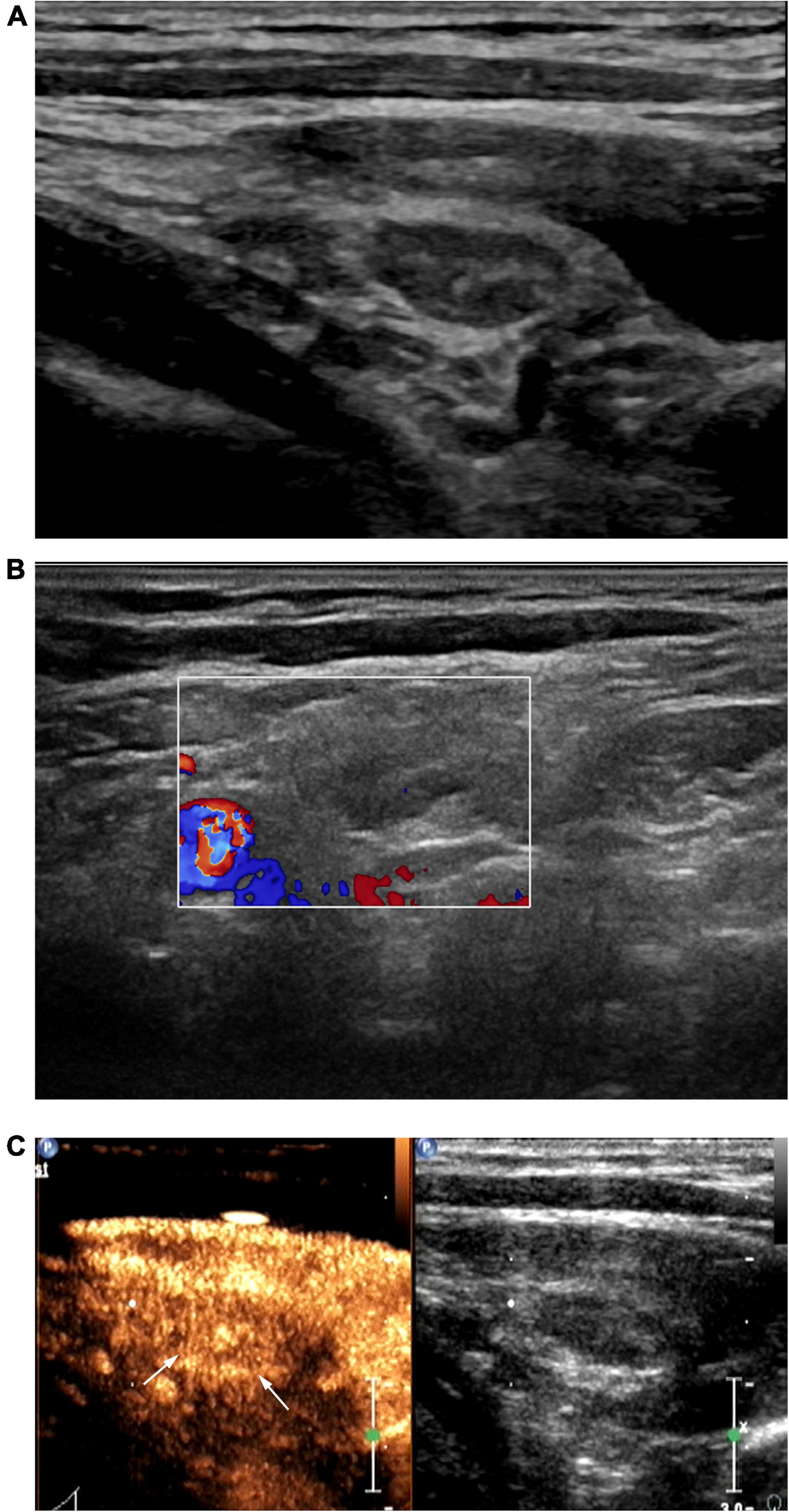 Frontiers Value Of Contrast Enhanced Ultrasound In The Ultrasound