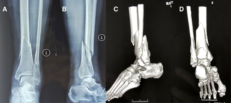 Malunited fracture - tibia, Radiology Case