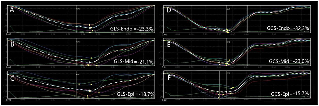 Frontiers  Evaluation of left ventricular myocardial stratified