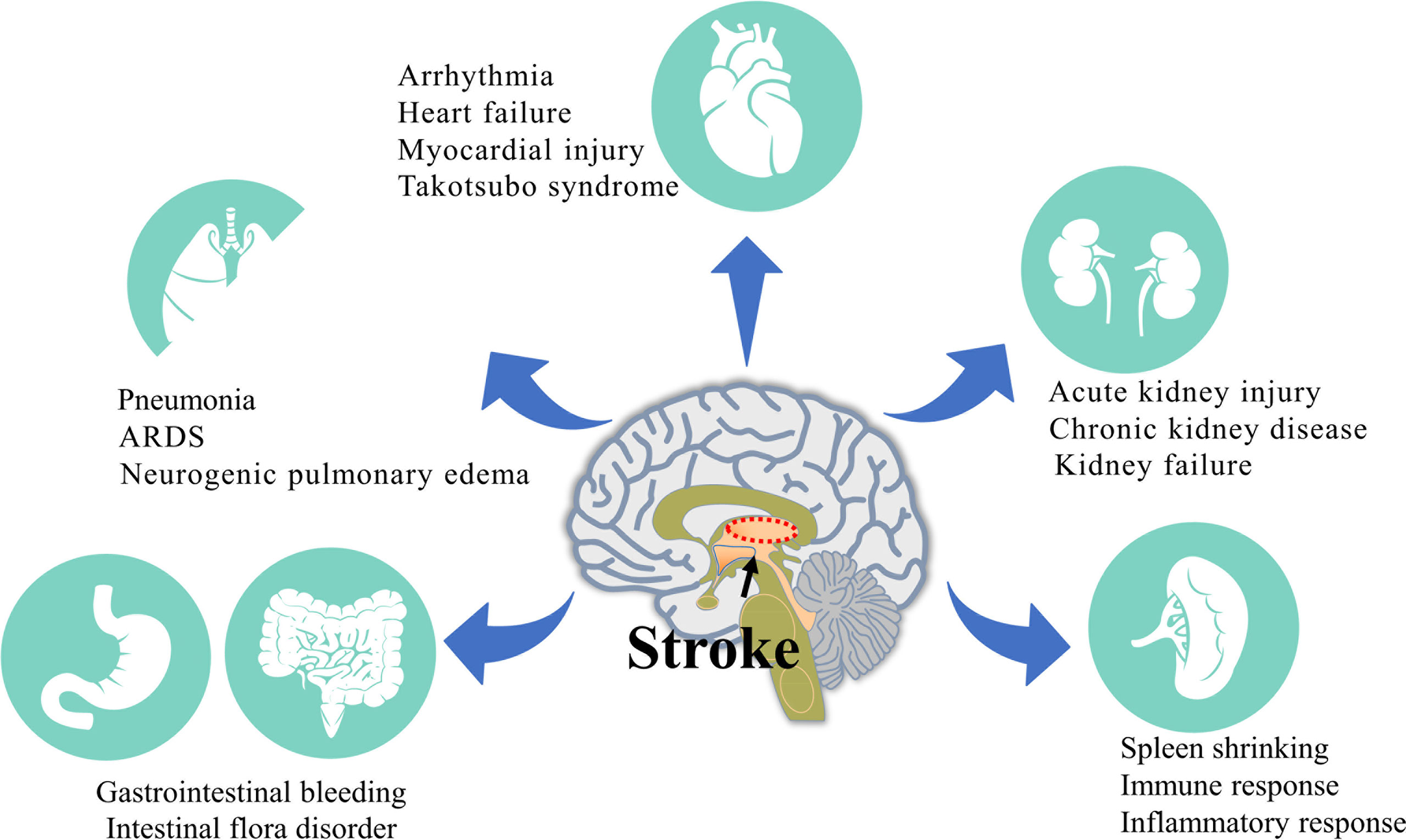 Frontiers | Peripheral Organ Injury After Stroke