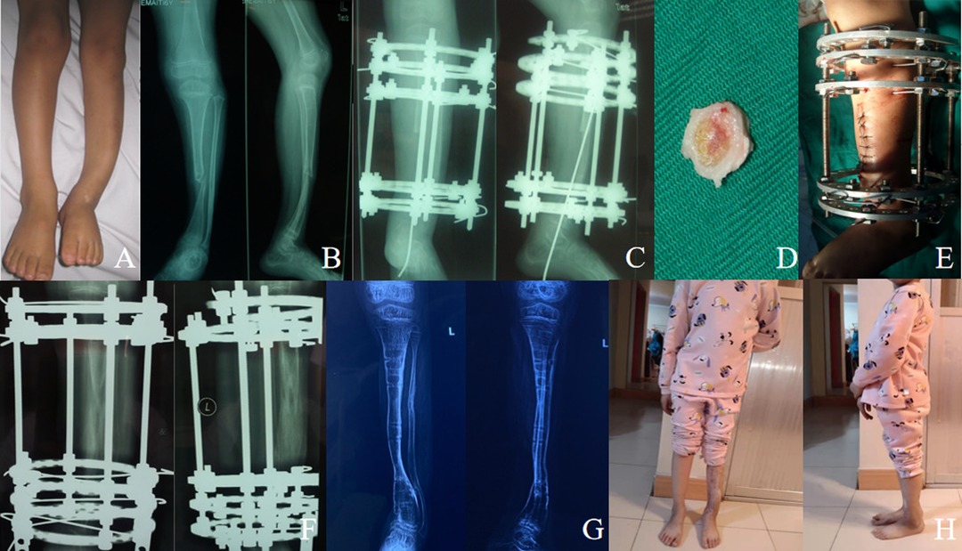 The outcomes of Ilizarov treatment in aseptic nonunions of the tibia  stratified by treatment strategies and surgical techniques