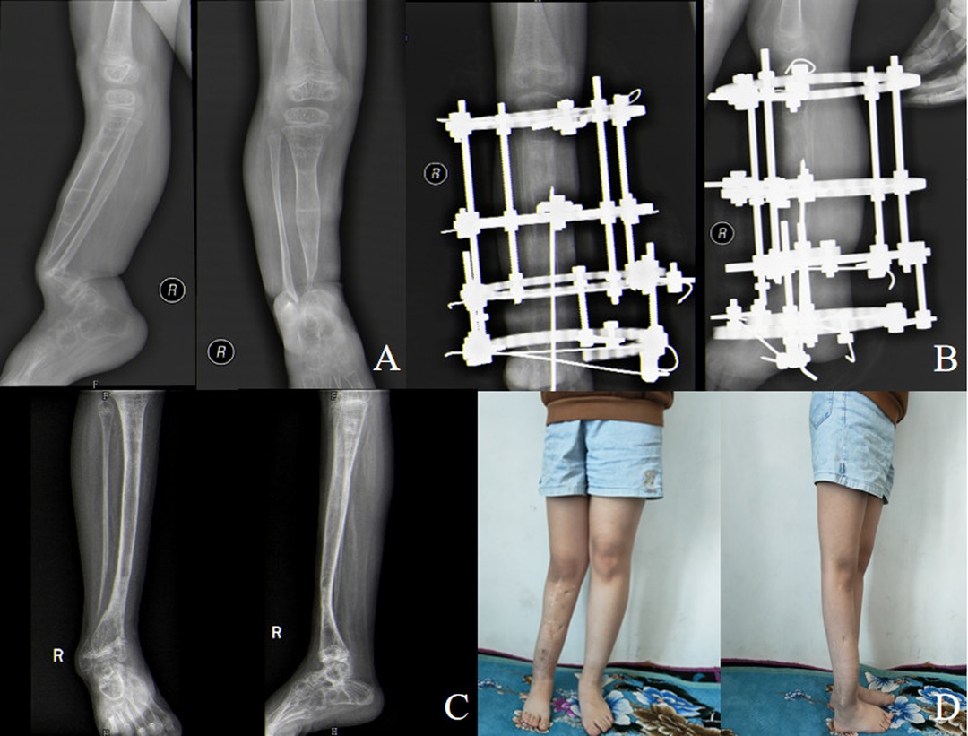 Full-ring Ilizarov frame applied for lengthening of tibia.